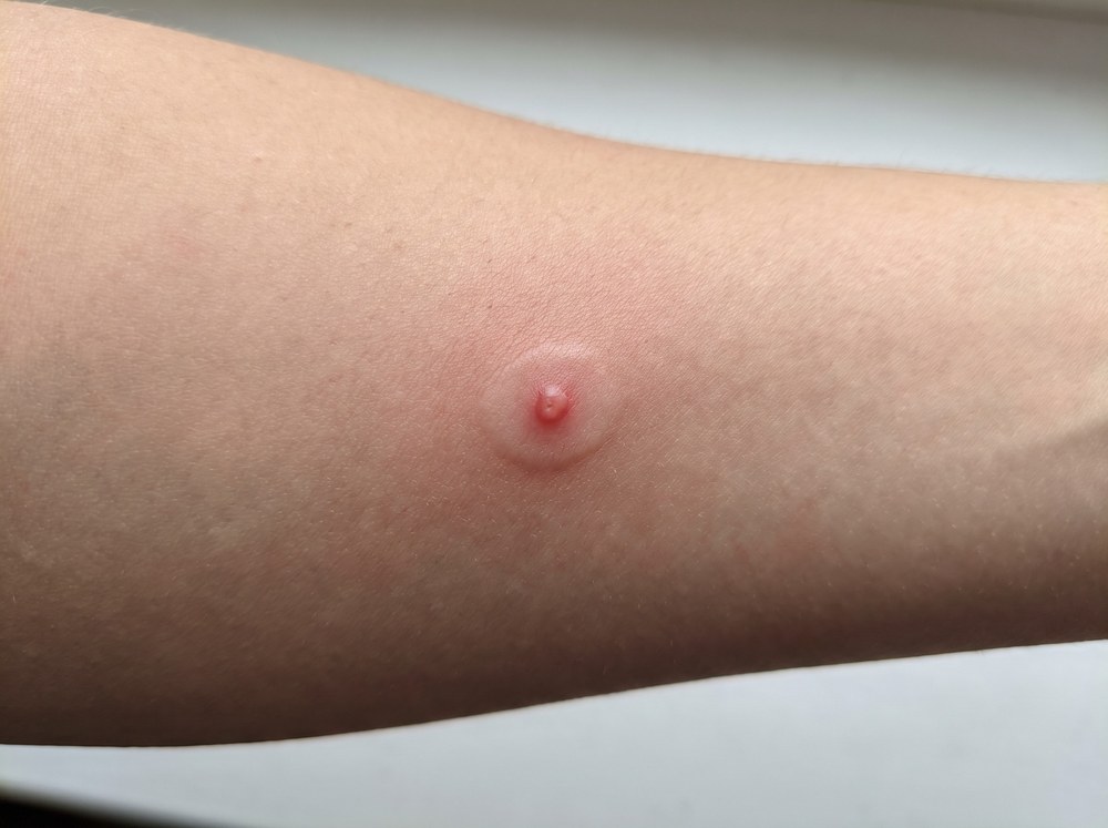 Close-up photo of a fresh bald-faced hornet sting showing a raised red welt with swelling and redness around it